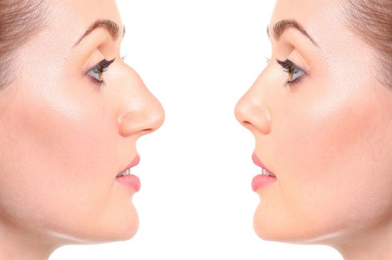 Rhinoplasty