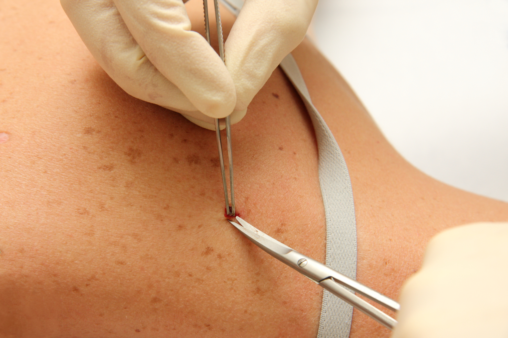 Skin Cancer Treatment Naperville - Melanoma Screening Plainfield IL