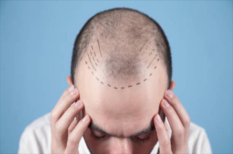 Hair Transplant