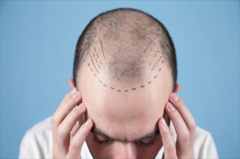 Hair Transplant