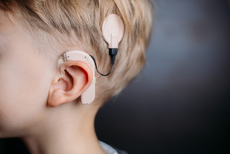 Cochlear Implant Rhazes Global