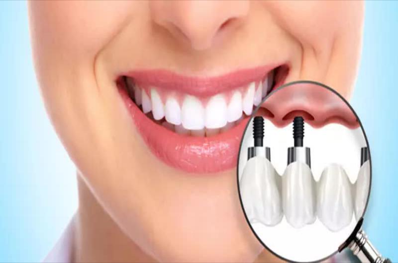 Tooth Implant